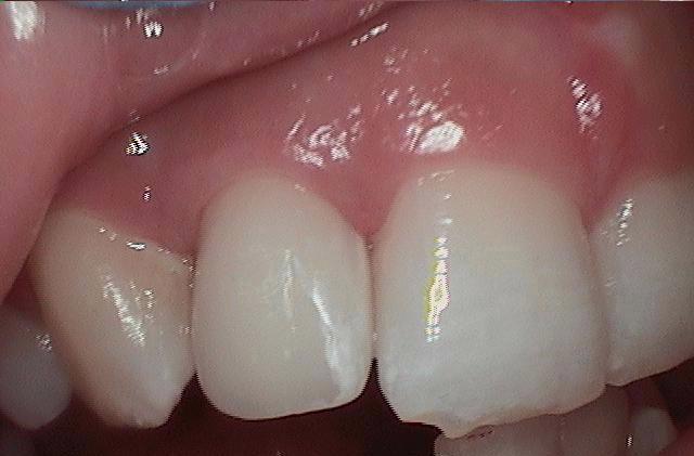 Implants-After-Image