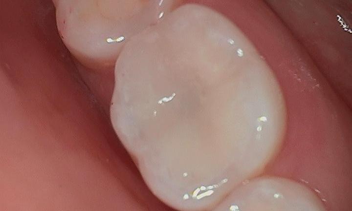 White-Filling-Composite-After-Image
