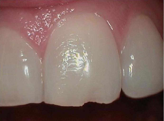 Chipped-Tooth-Before-Image