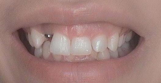 Implants-Before-Image