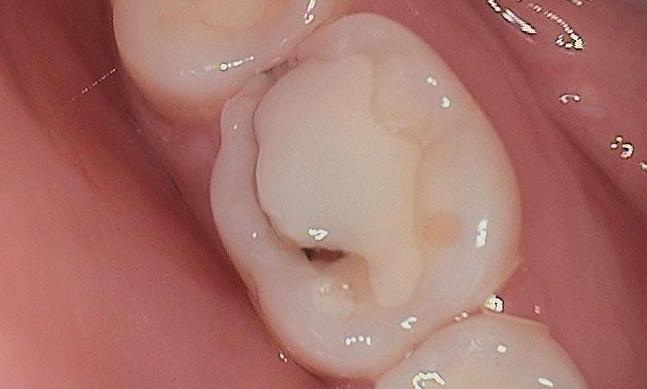 White-Filling-Composite-Before-Image